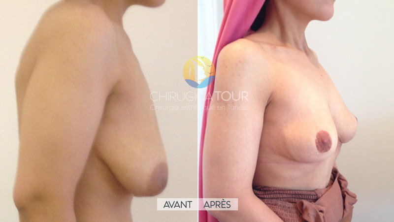 Lifting des seins (Sans prothèses) Tunisie