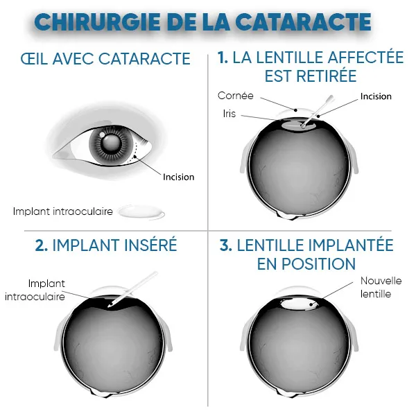 Chirurgie cataracte Tunisie