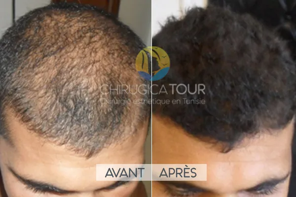 Greffe de cheveux Tunisie