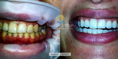 Blanchiment dentaire Tunisie