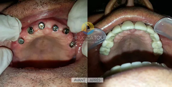 Implants dentaires Tunisie